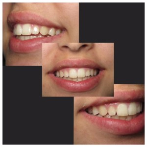 Before veneers