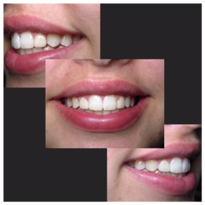 After veneers
