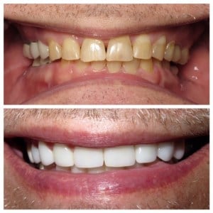 Before and after orthodontics and crowns