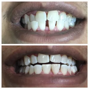 Before and after bonding