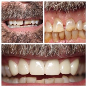 Before and after full-coverage crowns