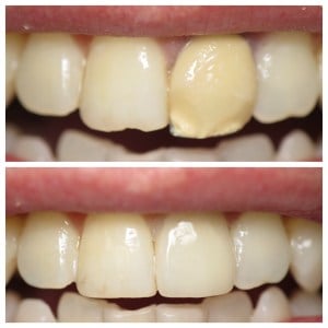 Before and after a new crown