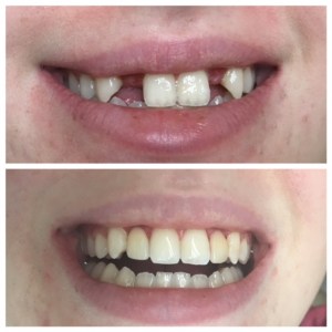 Before and after Maryland bridges