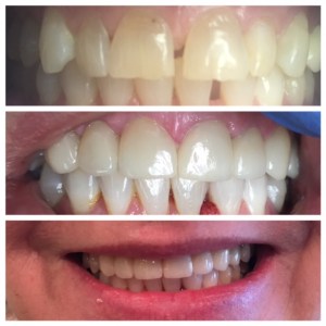 Before and after full crowns