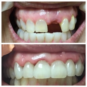 Before and after dental bridge