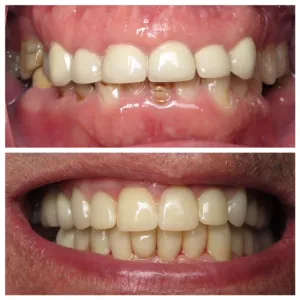 Before and after full-mouth rehabilitation