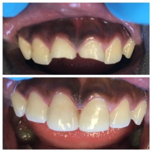 Before and after tooth-colored bonding
